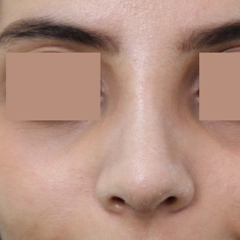 25-34 year old woman treated with Rhinoplasty after 3565682