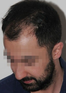 33 year old man treated with FUE Hair Transplant-13 days post op. 2832836