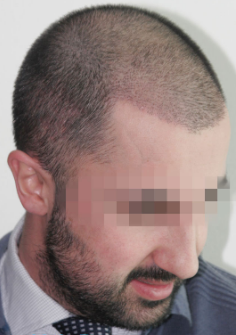 33 year old man treated with FUE Hair Transplant-13 days post op. after 2832836