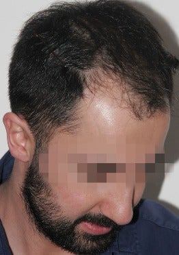 33 year old man treated with FUE Hair Transplant-13 days post op. before 2832836