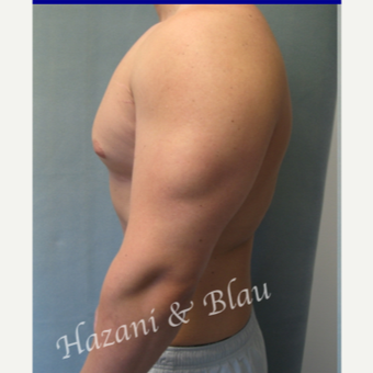18-24 year old man treated with Male Breast Reduction before 3332924