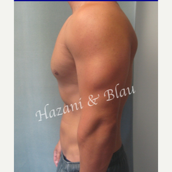 18-24 year old man treated with Male Breast Reduction after 3332924