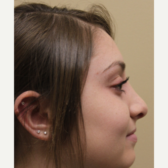 17 or under year old woman treated with Rhinoplasty after 3651243