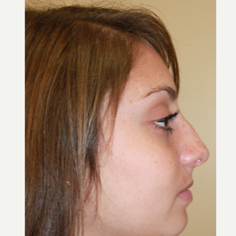 17 or under year old woman treated with Rhinoplasty before 3651243