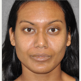 55-64 year old woman treated with Rhinoplasty before 3181705