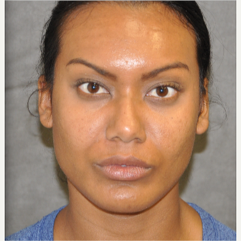 55-64 year old woman treated with Rhinoplasty after 3181705