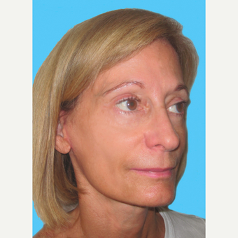 Facelift after 3826936
