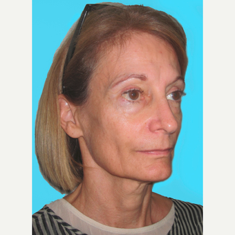 Facelift before 3826936