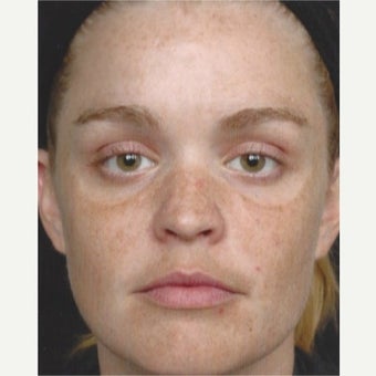 25-34 year old woman treated with Age Spots Treatment with Obagi Nu Derm Skin Transformation System before 2581711