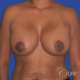 35 year old woman had a Donut Breast Lift after 3641044