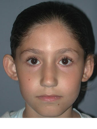 Otoplasty, Ear Surgery before 731949