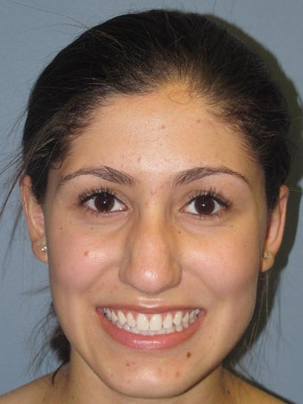 Otoplasty, Ear Surgery after 731949
