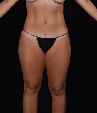 35-44 year old woman treated with SAFELipo after 3126417