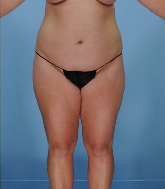 35-44 year old woman treated with SAFELipo before 3126417