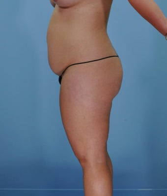 35-44 year old woman treated with SAFELipo 3126417