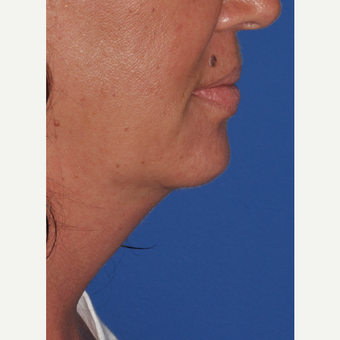 Kybella injection to reduce submental neck fat after 3375041