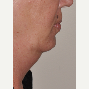 Kybella injection to reduce submental neck fat before 3375041