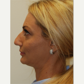 35-44 year old woman treated with Rhinoplasty before 3388025