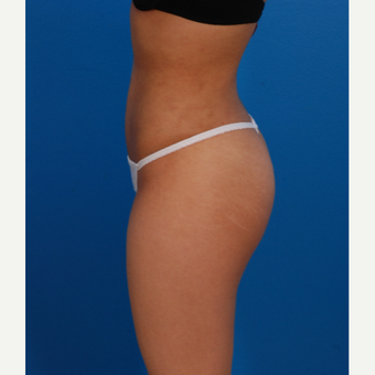 18 year old woman treated with liposuction to the circumferential trunk 1861595