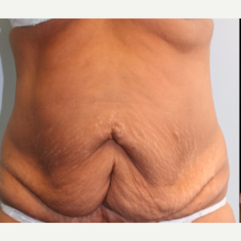 55-64 year old woman treated with Tummy Tuck before 3399492