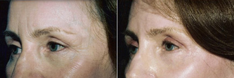 Chemical Peel before 1431807