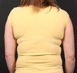 Bra Line Back Lift 567577