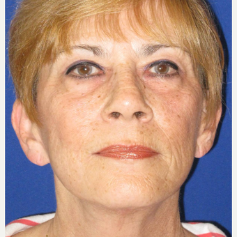 65-74 year old woman treated with Facelift after 3084697