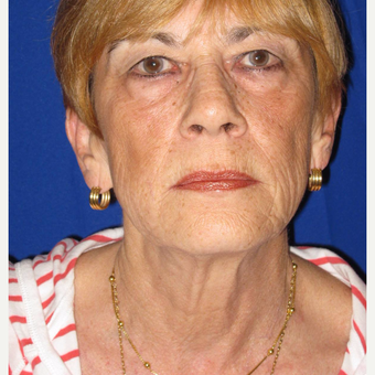 65-74 year old woman treated with Facelift before 3084697