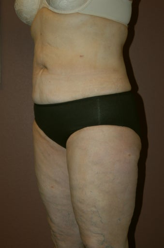 Liposuction after 342256