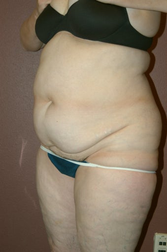 Liposuction before 342256