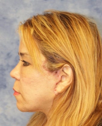 45-54 year old woman treated with Facelift after 3359474