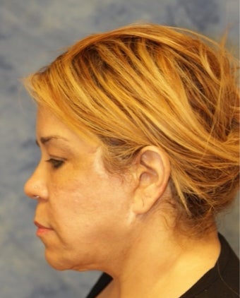 45-54 year old woman treated with Facelift before 3359474