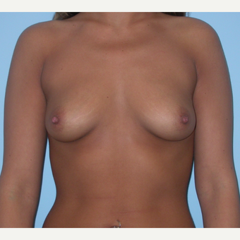 25 year old woman treated with Breast Augmentation and increasing form B to D cup size before 3212861