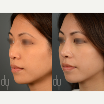 Asian Rhinoplasty with DCF before 3129941