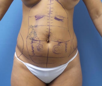 35-44 year old woman treated with Smart Lipo before 3097208