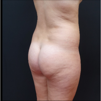 18-24 year old woman treated with Butt Augmentation before 3315493