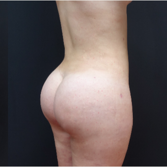 18-24 year old woman treated with Butt Augmentation after 3315493