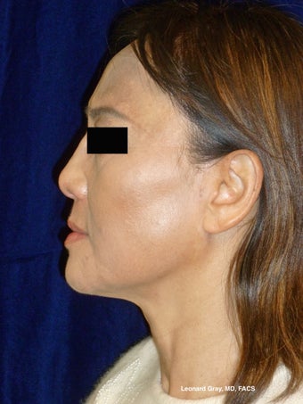 ThermiTight Brow, Lower Face, and Neck after 1450554