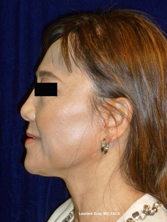 ThermiTight Brow, Lower Face, and Neck before 1450554