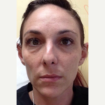 25-34 year old woman treated with Restylane before 3504941