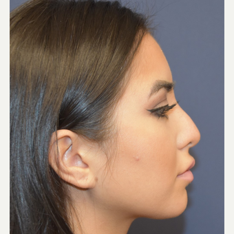 18-24 year old woman treated with Rhinoplasty before 3854711