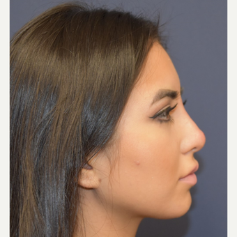 18-24 year old woman treated with Rhinoplasty after 3854711