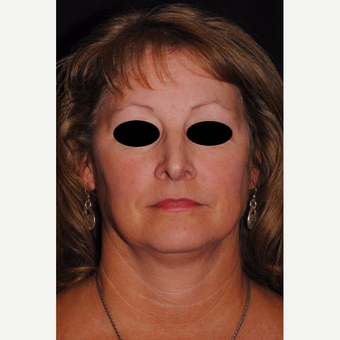 Autologous Fat Transfer and Precision TX facial liposuction to lower third of face before 3433720