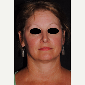 Autologous Fat Transfer and Precision TX facial liposuction to lower third of face after 3433720