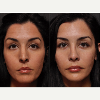 Rhinoplasty - Softening a Harsh Nose for Harmony and Beauty before 3138409