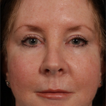 45-54 year old woman treated with Revision Rhinoplasty before 3208179