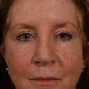 45-54 year old woman treated with Revision Rhinoplasty after 3208179