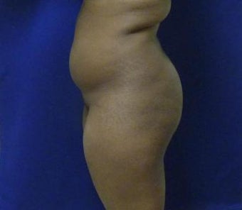 Brazilian Butt Lift via fat transfer 966767