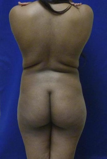Brazilian Butt Lift via fat transfer before 966767