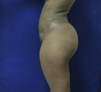 Brazilian Butt Lift via fat transfer 966767